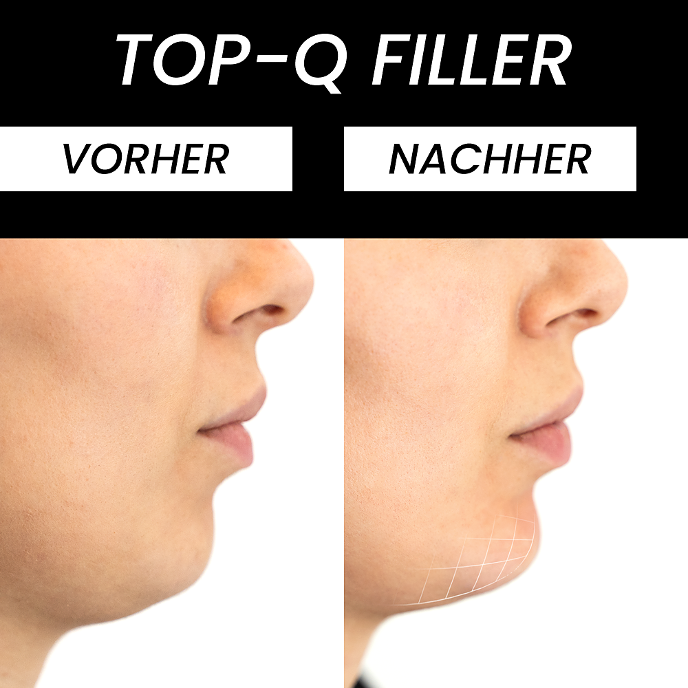 Before and after comparison of hyaluronic acid treatment